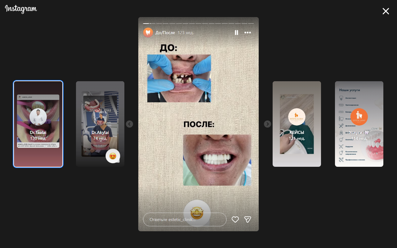 Результат работы — виниры до и после