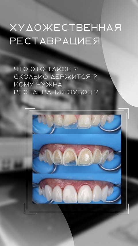 После лечения -- полная реставрация