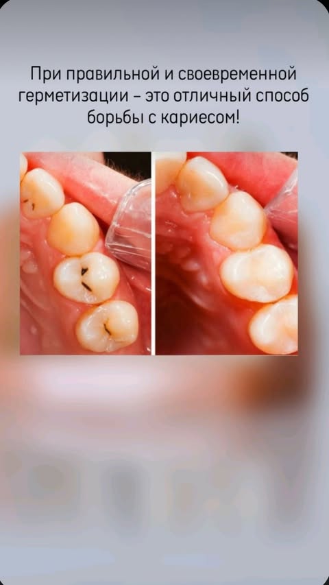 До лечения кариеса