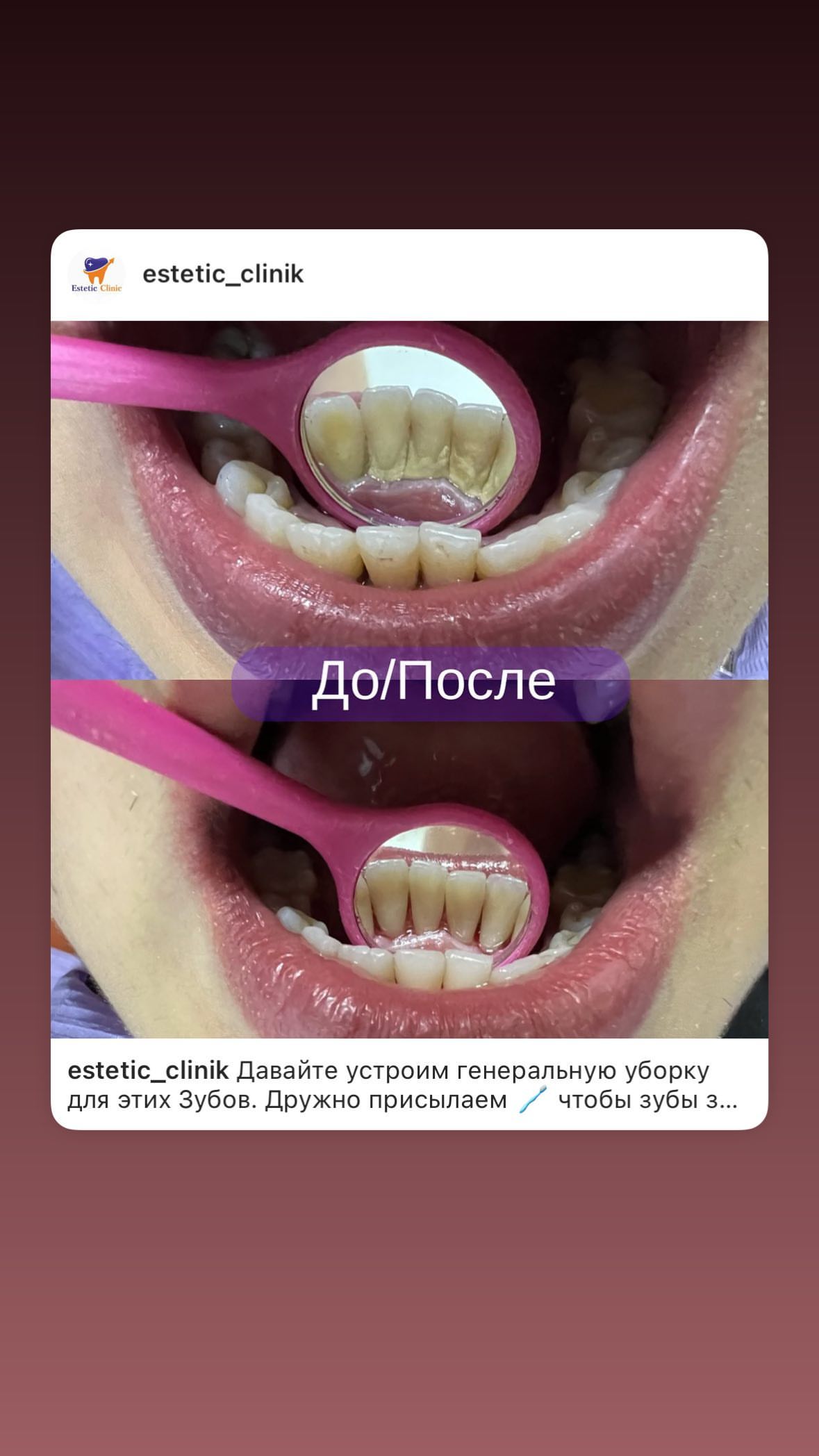 Брекеты — ортодонтия