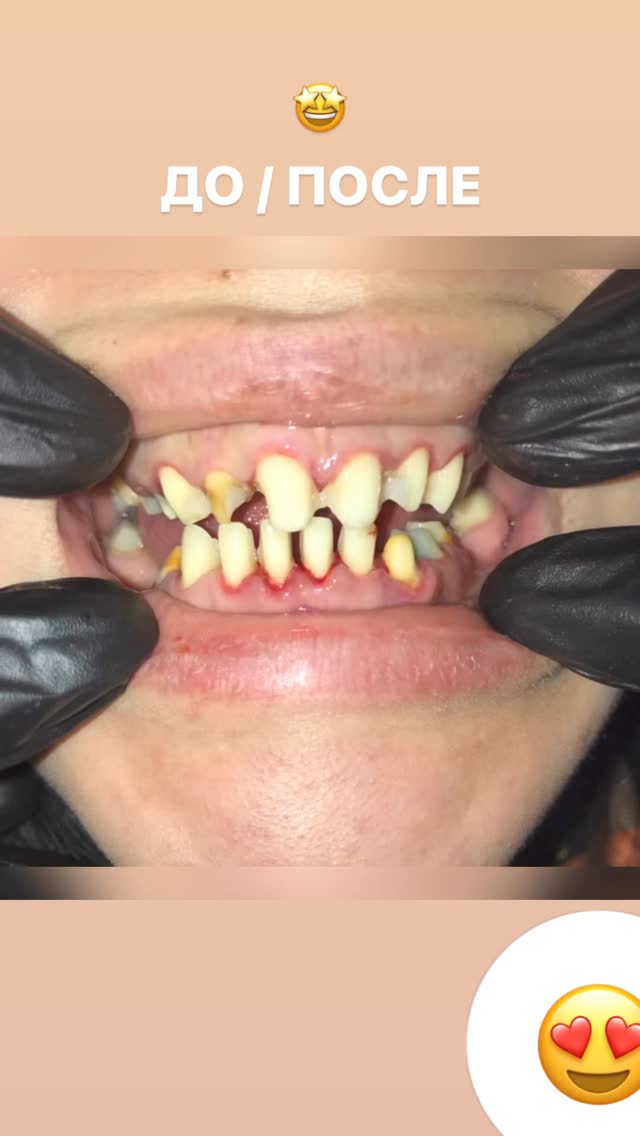 До/После — имплантация