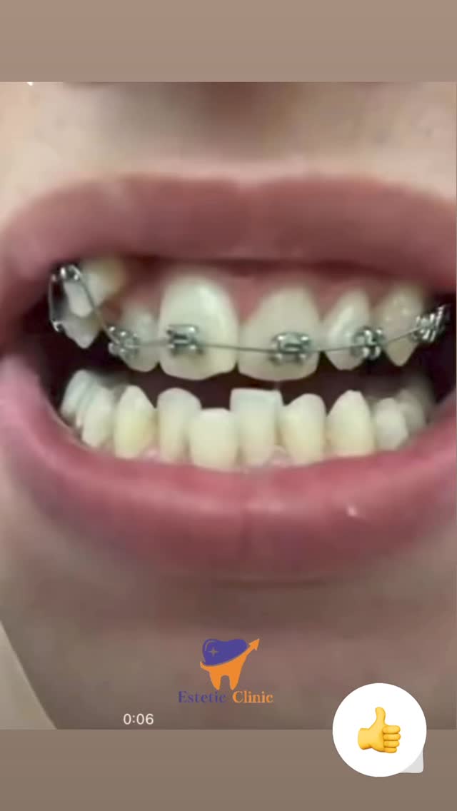 До/После — коронки